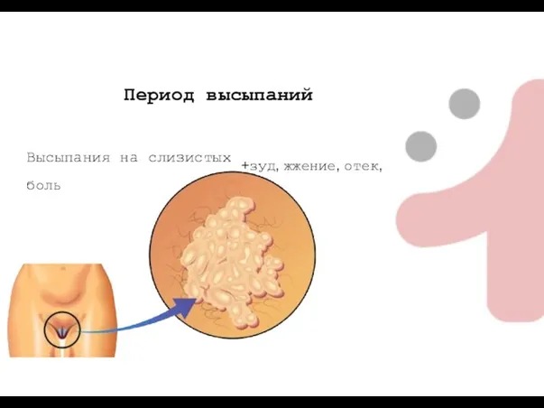 Период высыпаний Высыпания на слизистых +зуд, жжение, отек, боль