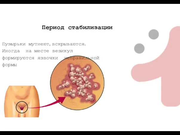 Период стабилизации Пузырьки мутнеют, вскрываются. Иногда на месте везикул формируются язвочки неправильной формы