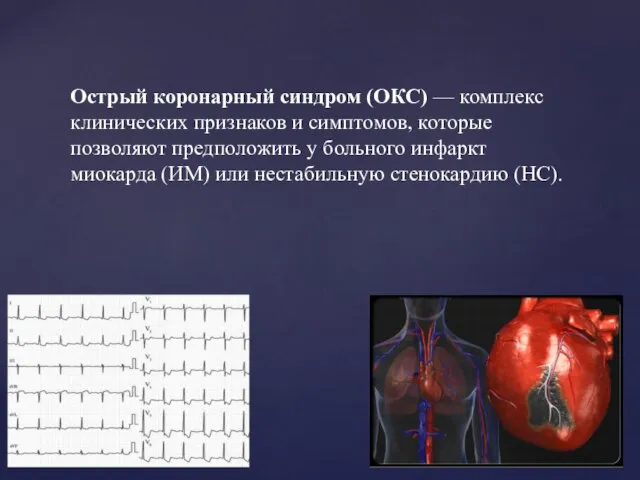 Острый коронарный синдром (ОКС) — комплекс клинических признаков и симптомов, которые позволяют