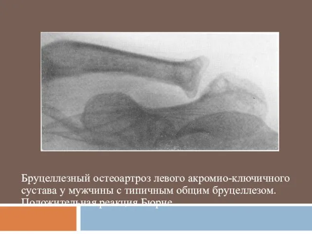 Бруцеллезный остеоартроз левого акромио-ключичного сустава у мужчины с типичным общим бруцеллезом. Положительная реакция Бюрне.