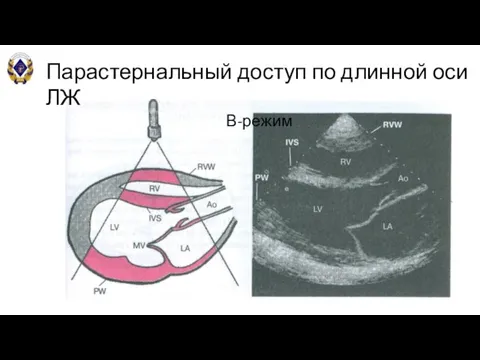 Парастернальный доступ по длинной оси ЛЖ В-режим