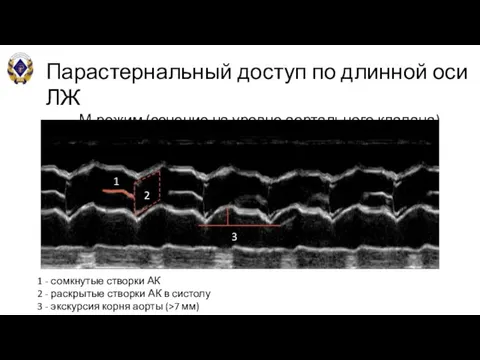 Парастернальный доступ по длинной оси ЛЖ М-режим (сечение на уровне аортального клапана)