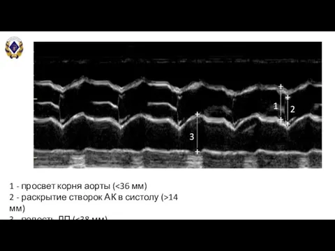1 2 3 1 - просвет корня аорты ( 2 - раскрытие