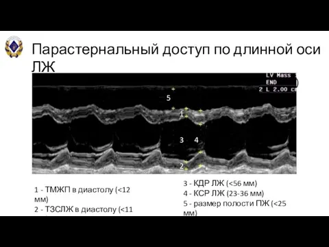 Парастернальный доступ по длинной оси ЛЖ М-режим (сечение на уровне папиллярных мышц)