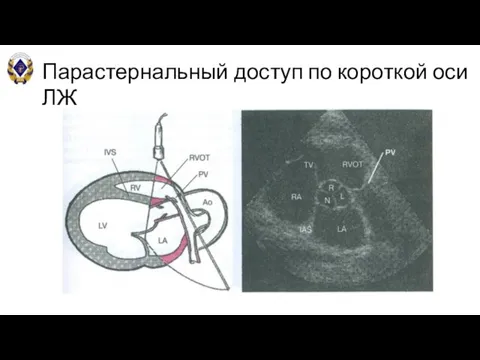 Парастернальный доступ по короткой оси ЛЖ В-режим (на уровне аортального клапана)