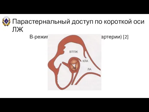 Парастернальный доступ по короткой оси ЛЖ В-режим (на уровне легочной артерии) [2]