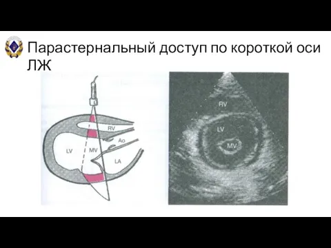 Парастернальный доступ по короткой оси ЛЖ В-режим (на уровне митрального клапана)