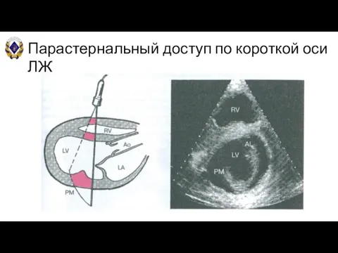 Парастернальный доступ по короткой оси ЛЖ В-режим (на уровне папиллярных мышц)