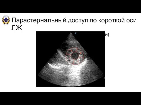 Парастернальный доступ по короткой оси ЛЖ В-режим (на уровне верхушки)