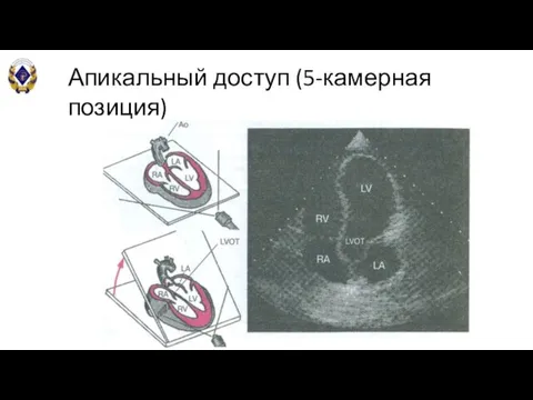 Апикальный доступ (5-камерная позиция) Отклонить плоскость сканирования кверху