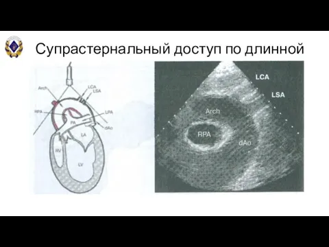 Супрастернальный доступ по длинной оси