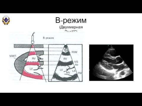 В-режим (Двухмерная ЭхоКГ)