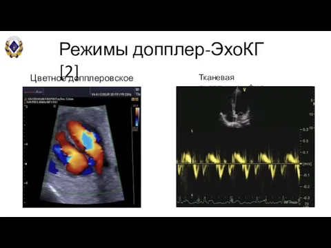 Режимы допплер-ЭхоКГ [2] Цветное допплеровское картирование Тканевая допплерография