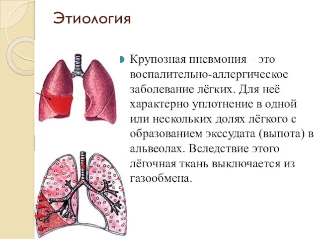 Этиология Крупозная пневмония – это воспалительно-аллергическое заболевание лёгких. Для неё характерно уплотнение