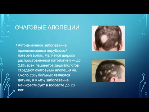 ОЧАГОВЫЕ АЛОПЕЦИИ Аутоиммунное заболевание, проявляющееся нерубцовой потерей волос. Является широко распространенной патологией
