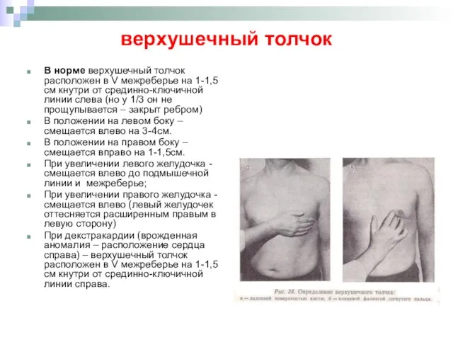 верхушечный толчок В норме верхушечный толчок расположен в V межреберье на 1-1,5см