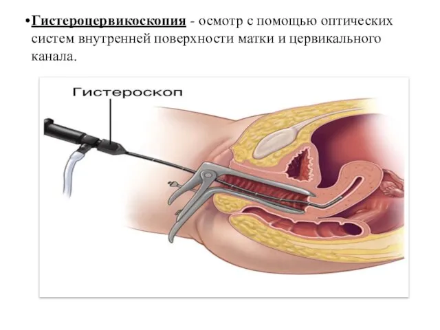 Гистероцервикоскопия - осмотр с помощью оптических систем внутренней поверхности матки и цервикального канала.