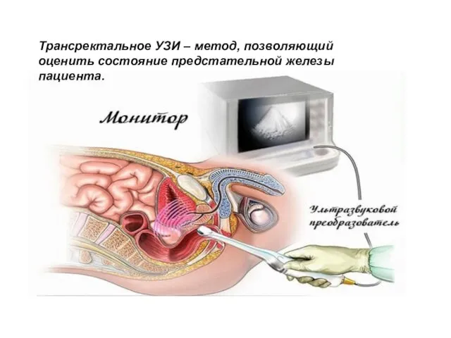 Трансректальное УЗИ – метод, позволяющий оценить состояние предстательной железы пациента.