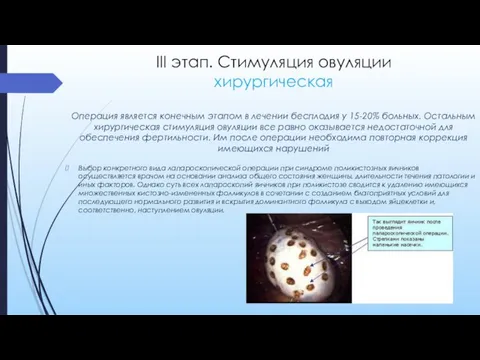 III этап. Стимуляция овуляции хирургическая Операция является конечным этапом в лечении бесплодия