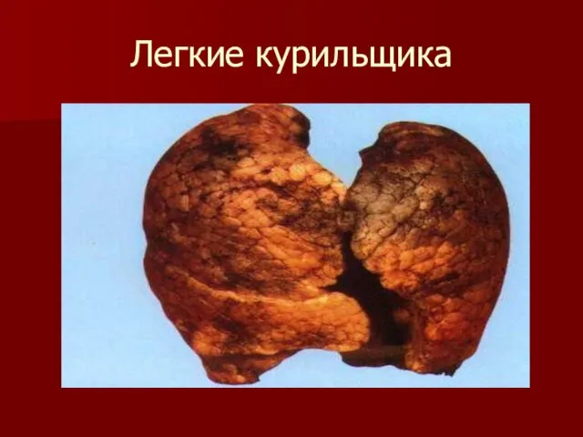 Легкие курильщика