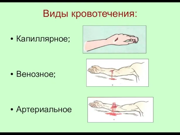 Виды кровотечения: Капиллярное; Венозное; Артериальное