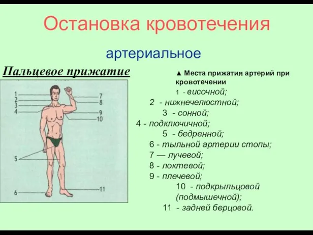 Остановка кровотечения артериальное Пальцевое прижатие ▲ Места прижатия артерий при кровотечении 1