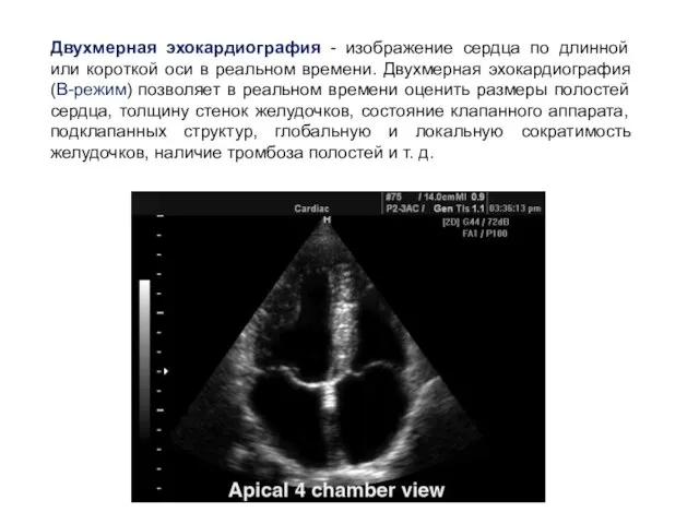 Двухмерная эхокардиография - изображение сердца по длинной или короткой оси в реальном