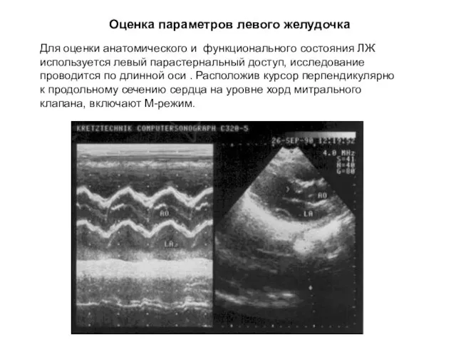 Оценка параметров левого желудочка Для оценки анатомического и функционального состояния ЛЖ используется