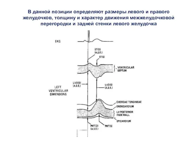 В данной позиции определяют размеры левого и правого желудочков, толщину и характер