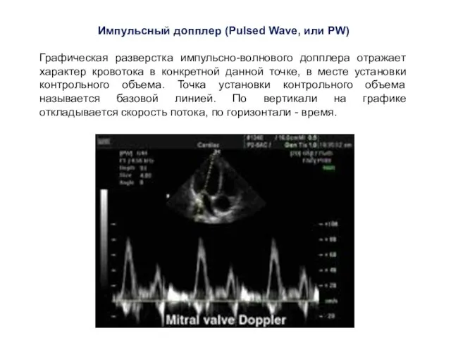 Импульсный допплер (Pulsed Wave, или PW) Графическая разверстка импульсно-волнового допплера отражает характер