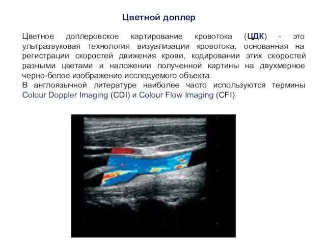 Цветное доплеровское картирование кровотока (ЦДК) - это ультразвуковая технология визуализации кровотока, основанная