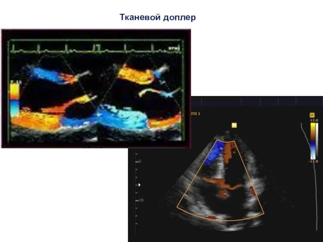 Тканевой доплер