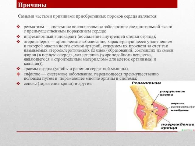 Самыми частыми причинами приобретенных пороков сердца являются: ревматизм — системное воспалительное заболевание