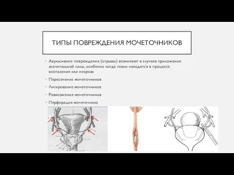 ТИПЫ ПОВРЕЖДЕНИЯ МОЧЕТОЧНИКОВ Авульсивное повреждения (отрывы) возникают в случаев приложения значительной силы,