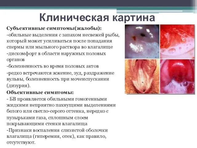 Клиническая картина Субъективные симптомы(жалобы): -обильные выделения с запахом несвежей рыбы, который может
