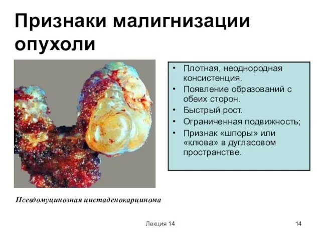 Лекция 14 Признаки малигнизации опухоли Плотная, неоднородная консистенция. Появление образований с обеих