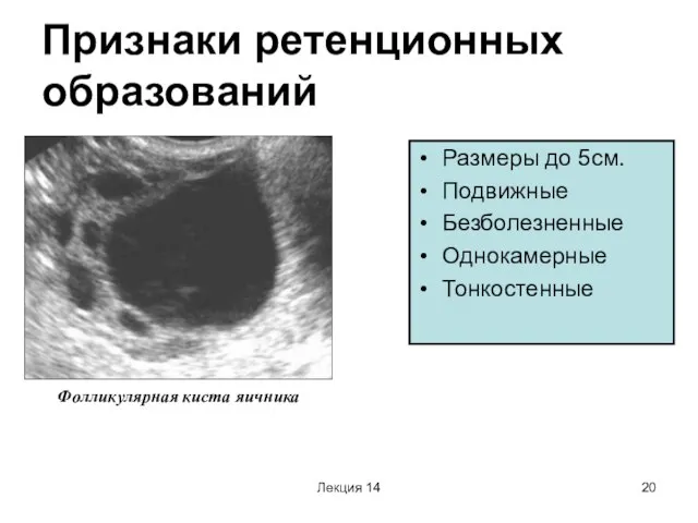 Лекция 14 Признаки ретенционных образований Размеры до 5см. Подвижные Безболезненные Однокамерные Тонкостенные Фолликулярная киста яичника