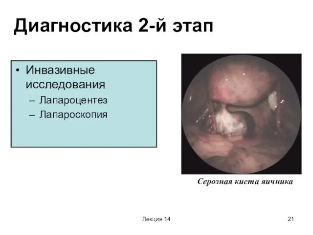 Лекция 14 Диагностика 2-й этап Инвазивные исследования Лапароцентез Лапароскопия Серозная киста яичника