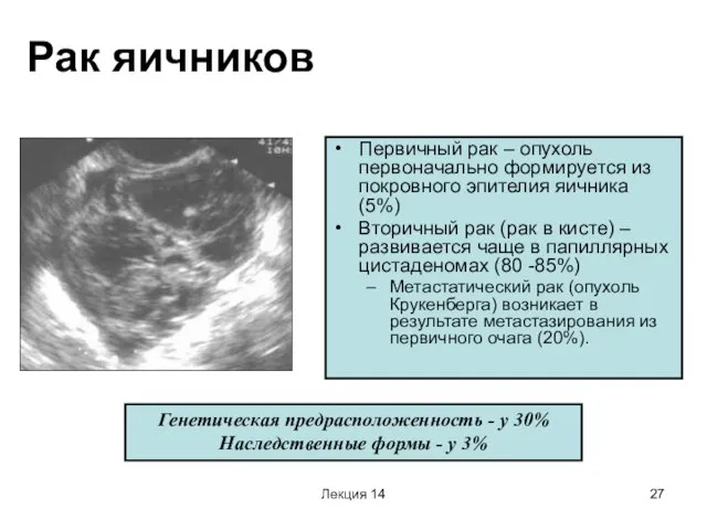 Лекция 14 Рак яичников Первичный рак – опухоль первоначально формируется из покровного