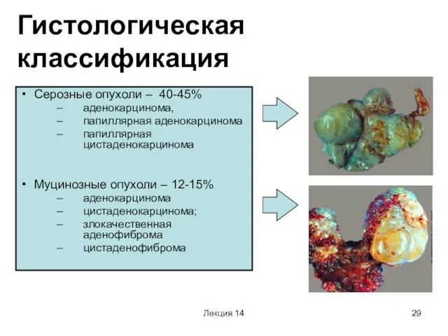 Лекция 14 Гистологическая классификация Серозные опухоли – 40-45% аденокарцинома, папиллярная аденокарцинома папиллярная