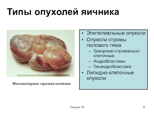 Лекция 14 Типы опухолей яичника Эпителиальные опухоли Опухоли стромы полового тяжа Гранулезо-стромально-