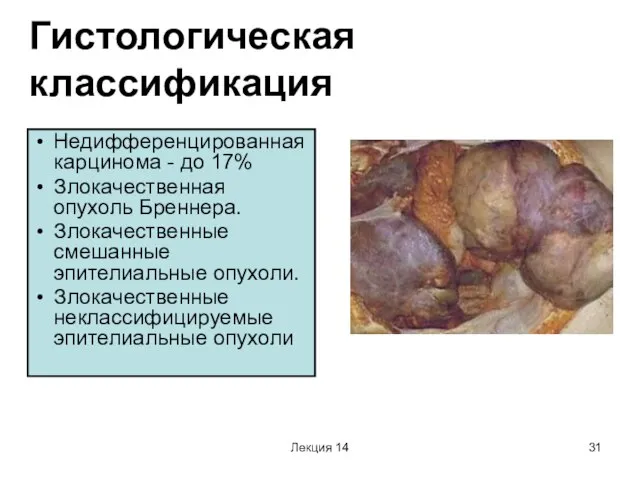 Лекция 14 Гистологическая классификация Недифференцированная карцинома - до 17% Злокачественная опухоль Бреннера.