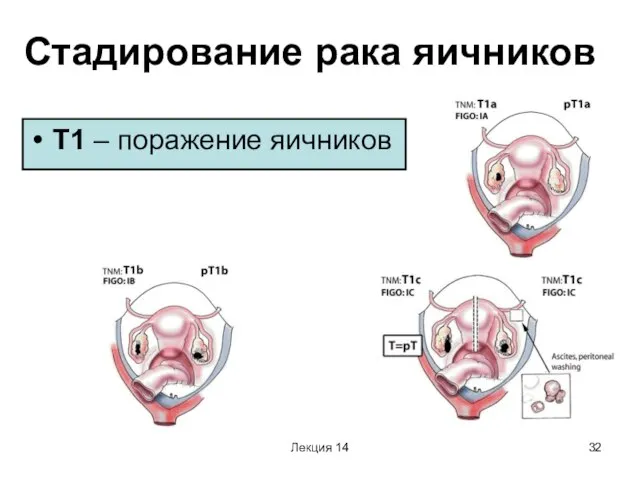 Лекция 14 Стадирование рака яичников Т1 – поражение яичников