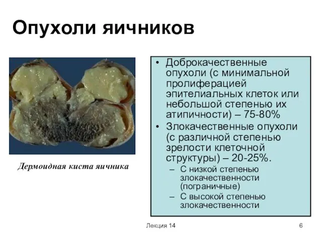 Лекция 14 Опухоли яичников Доброкачественные опухоли (с минимальной пролиферацией эпителиальных клеток или