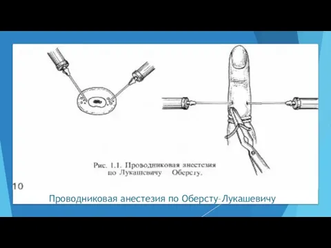 Проводниковая анестезия по Оберсту–Лукашевичу