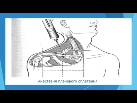 Анестезия плечевого сплетения