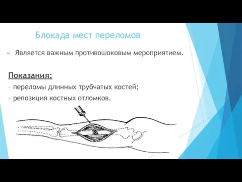 Блокада мест переломов Является важным противошоковым мероприятием. Показания: – переломы длинных трубчатых