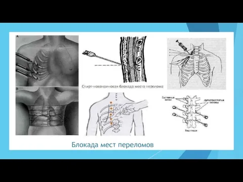 Блокада мест переломов