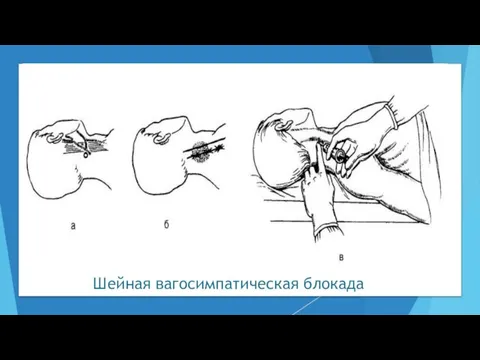 Шейная вагосимпатическая блокада