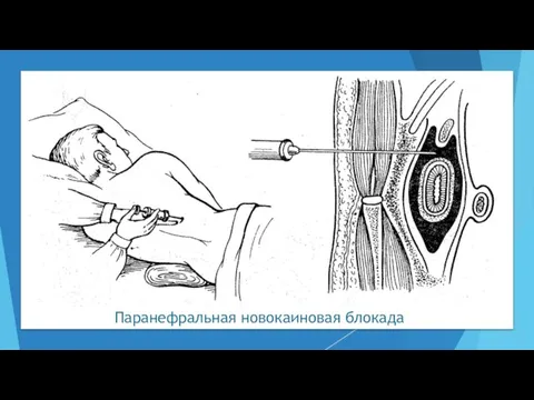 Паранефральная новокаиновая блокада